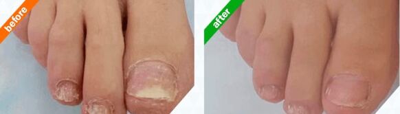 Снимки преди и след използване на продукта, опит от използването на Myceril