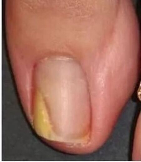 нокът на крака с гъбички преди лечение