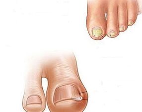 прогресия на гъбички на ноктите на краката
