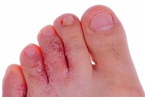 гъбички на пръстите на краката