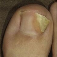 снимка на гъбички по ноктите на краката 2