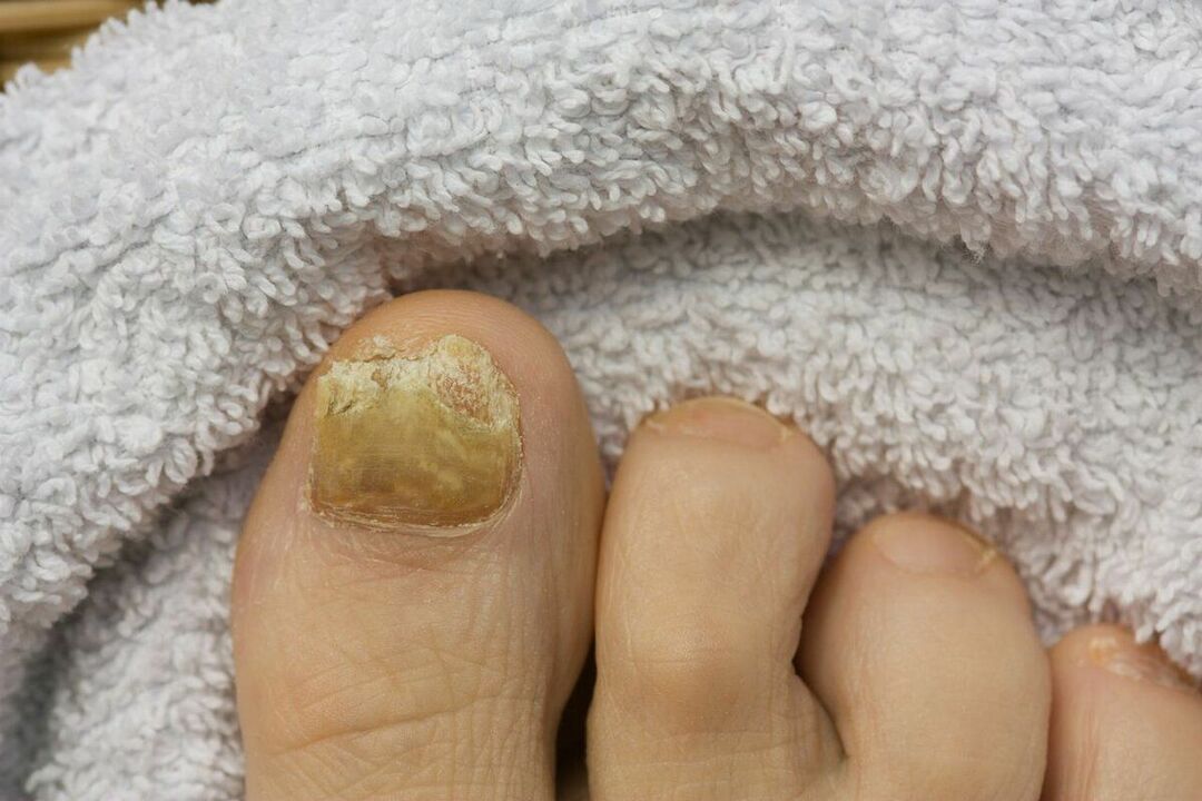 причини за гъбички по ноктите на краката
