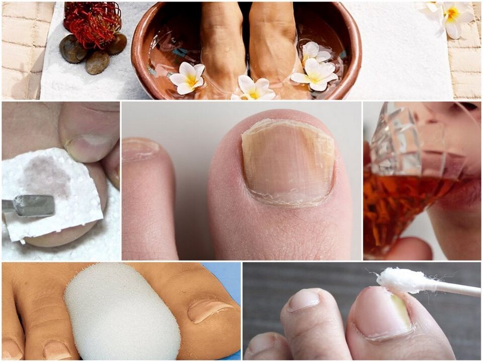 естествено лечение на гъбички по ноктите