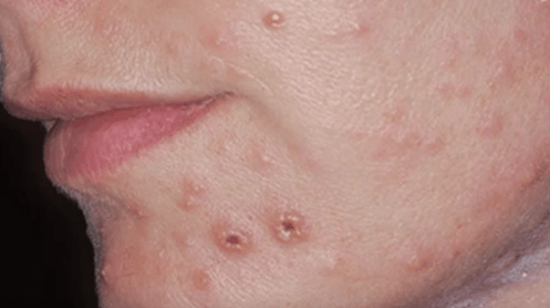 Гъбична инфекция на кожата на лицето