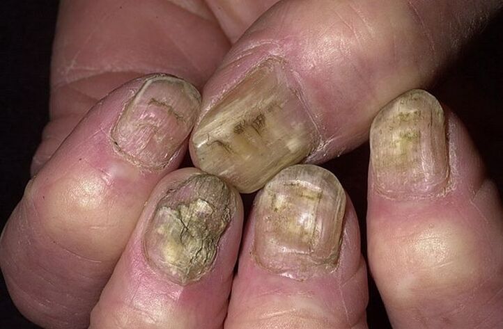 Деформация, отделяне и ронене на ноктите поради гъбички