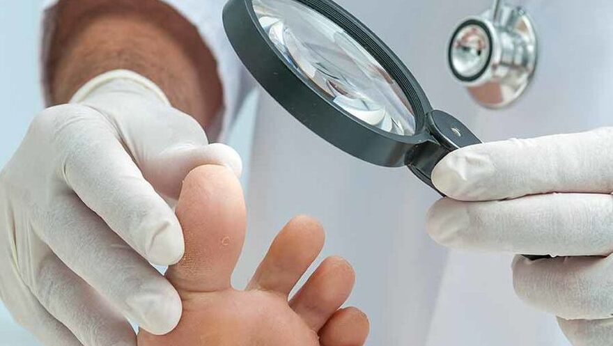 Диагностиката на гъбичките по ноктите на краката се извършва от дерматолог