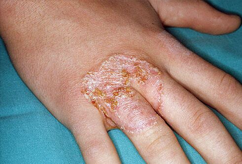 Червени петна под формата на огърлица по кожата на ръцете поради микоза